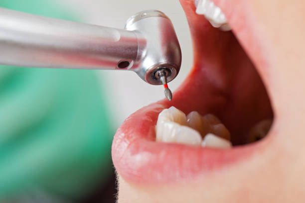 Best Emergency Treatment for Dental Infections or Abscesses in Altadena, CA